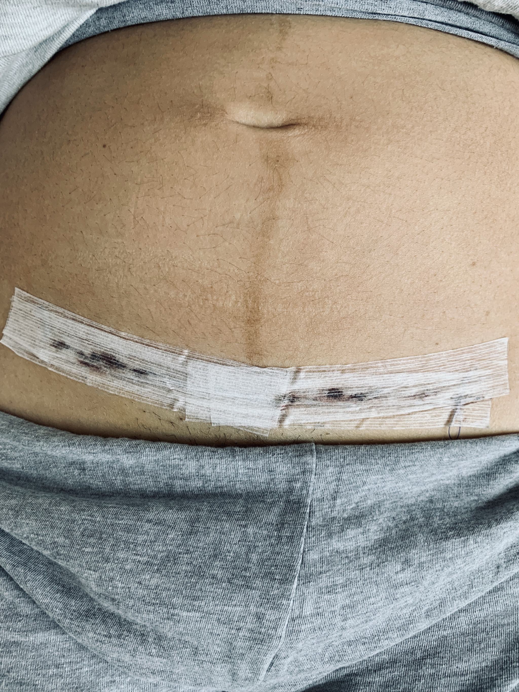 Kaiserschinttnarbe pfelgen